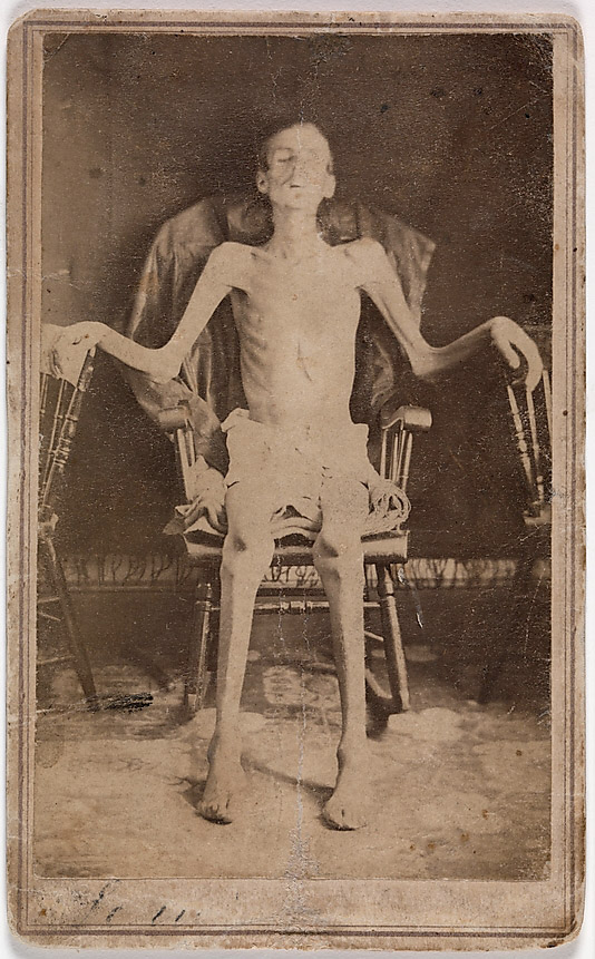 J. W. Jones, Emaciated Union Soldier Liberated from Andersonville Prison, 1860s, 1865, albumen silver print from glass negative, 9 x 5.5 cm (The Metropolitan Museum of Art, Brian D. Caplan Collection)